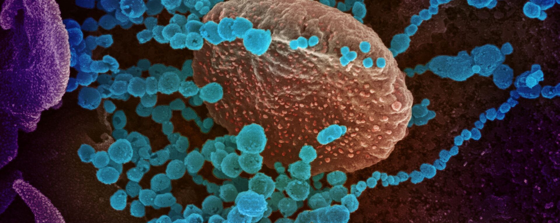 Вид на зараженную коронавирусом  клетку под микроскопом  - Sputnik Грузия, 1920, 24.06.2021