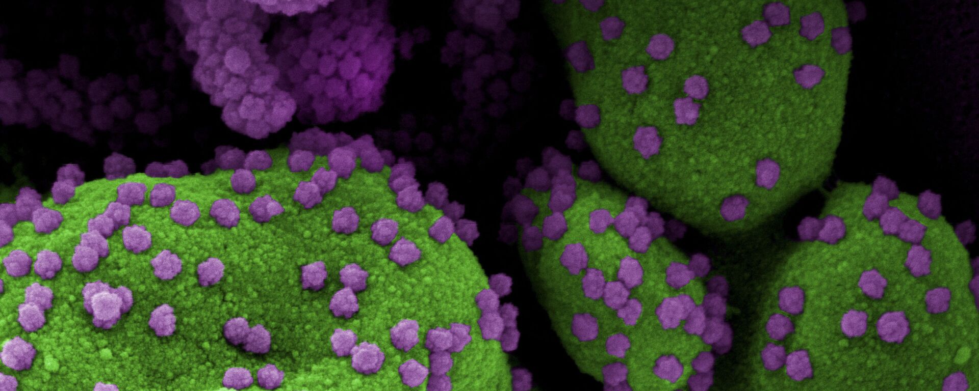 Пандемия коронавируса - COVID-19 и человеческие клетки изучаются под микроскопом - Sputnik Грузия, 1920, 25.11.2021