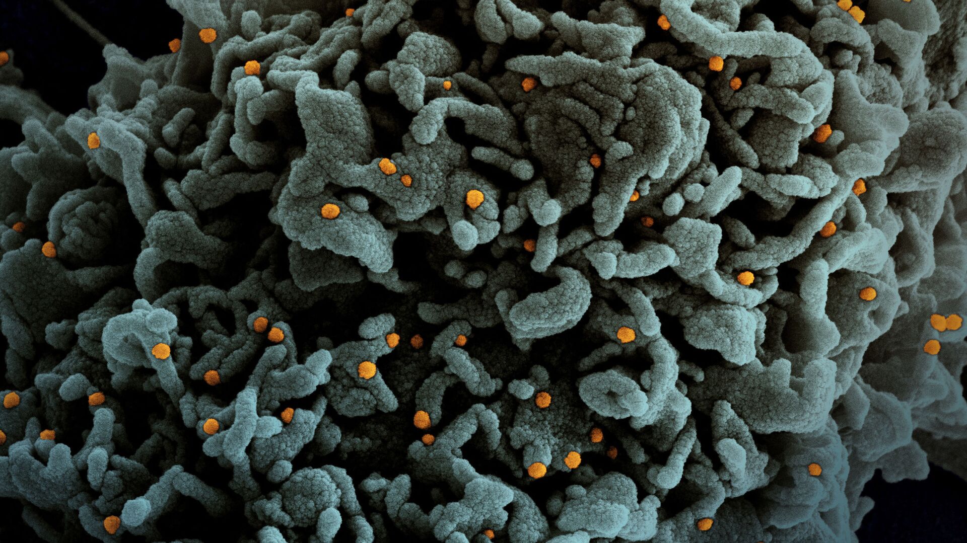 Пандемия коронавируса - COVID-19 и человеческие клетки изучаются под микроскопом - Sputnik Грузия, 1920, 24.08.2021