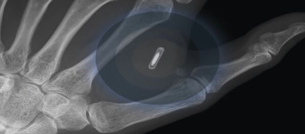 კანქვეშა ჩიპის ჩანერგვის პროცესი კანქვეშა ჩიპის ჩანერგვის პროცესი - Sputnik საქართველო