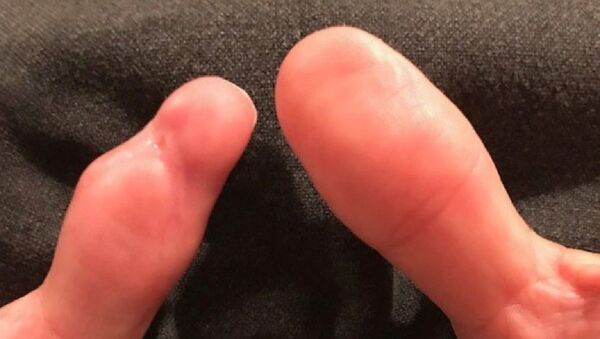 Пальцы, поврежденные во время инфекции, занесенной на маникюре - Sputnik Грузия